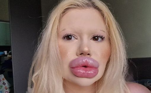 Дівчина з найбільшими у світі губами взялася за ніс
