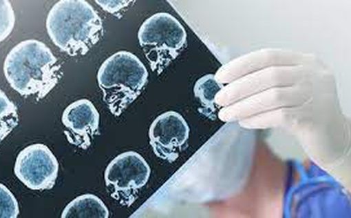 Симптоми, що свідчать про ранні ознаки хвороби Альцгеймера