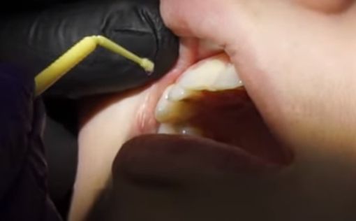 В Китае открыли способ лечения зубов без пломб
