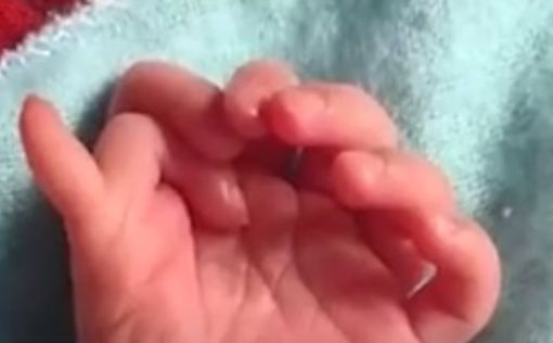Рідкісне явище: дівчинка народилася з 26-ма пальцями
